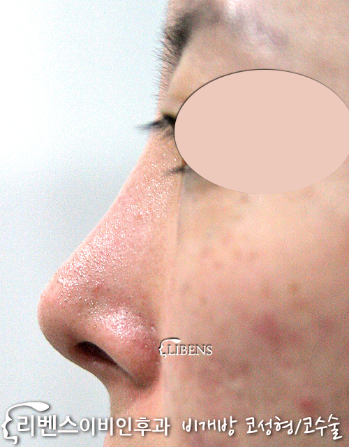 여자 매부리코 메부리코 제거 낮은 코끝 높이기 수술 교정  성형 s220